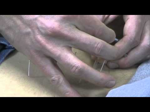 Acupuncture Lake Havasu City AZ Low Back Pain Chiropractor